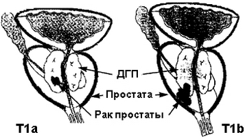 Кальцинаты предстательной железы что это такое